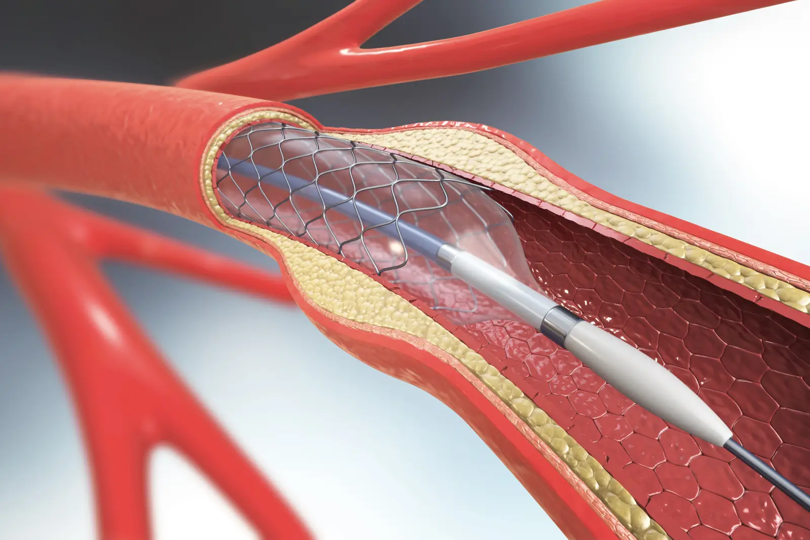 Illustration of a balloon catheter expanding a mesh stent inside an artery narrowed by plaque.